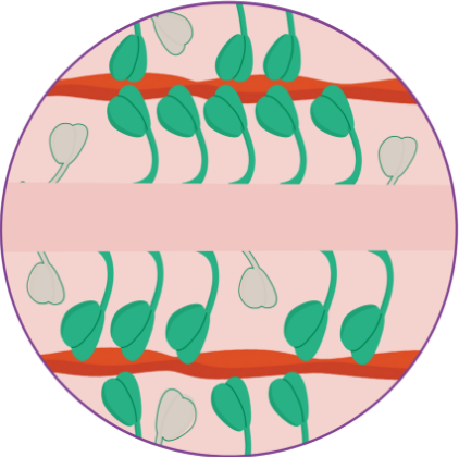 Heart with obstructive hypertrophic cardiomyopathy (oHCM)