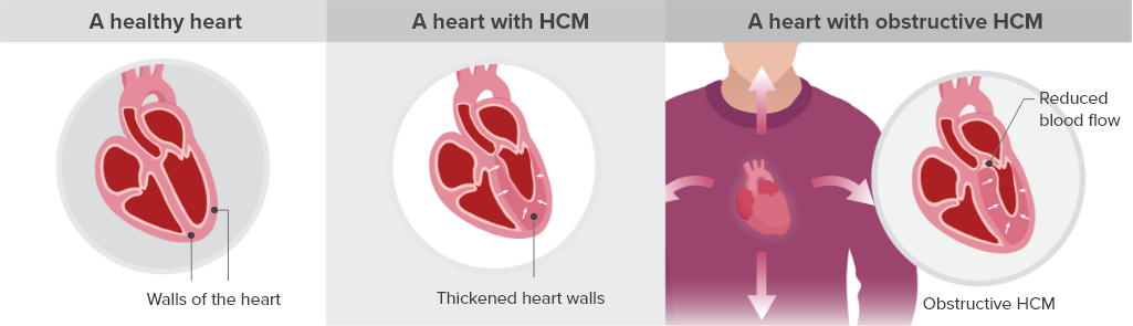 A healthy heart, a heart with hypertrophic cardiomyopathy (HCM), and a heart with obstructive hypertrophic cardiomyopathy (oHCM)