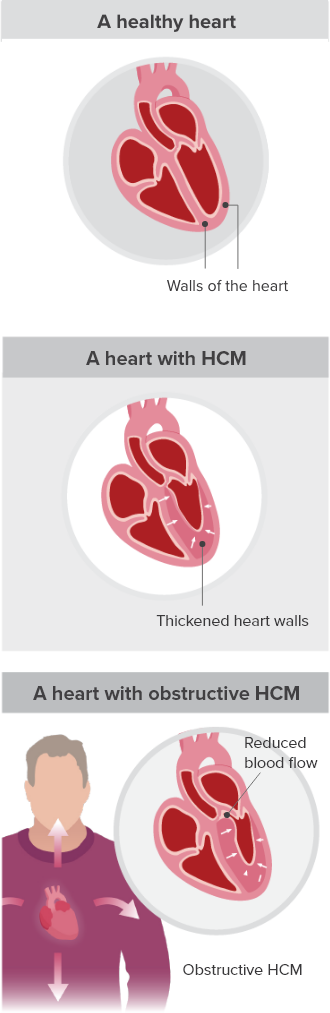 A healthy heart, a heart with hypertrophic cardiomyopathy (HCM), and a heart with obstructive hypertrophic cardiomyopathy (oHCM)