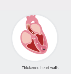A heart with hypertrophic cardiomyopathy (HCM)