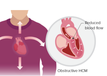 A heart with obstructive hypertrophic cardiomyopathy (oHCM)